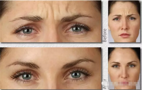 川字纹可以手术去除吗 关于眉间纹手术你不知道的事