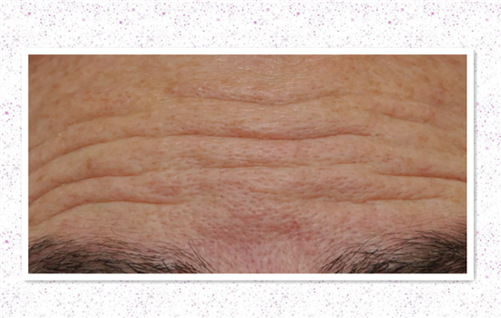 抬头纹除皱针副作用 不正规注射的情况下副作用很多