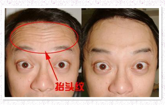 额头除皱多久见效 不同治疗方法见效时间当然不同