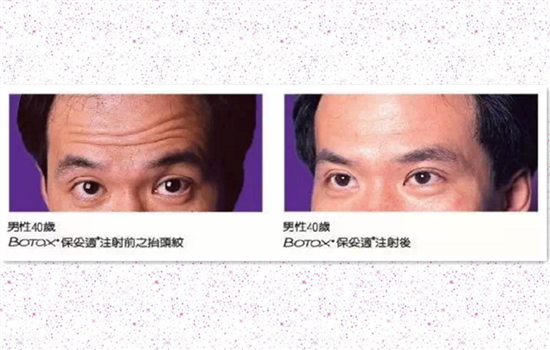 抬头纹去皱方法 女神都用这5种办法拯救抬头纹