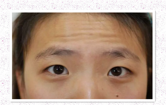 抬头纹去皱方法 女神都用这5种办法拯救抬头纹