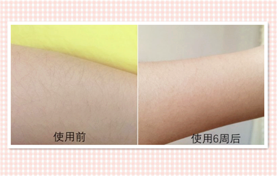 silkn脱毛仪好用吗 选择适合自己的不再做猕猴桃