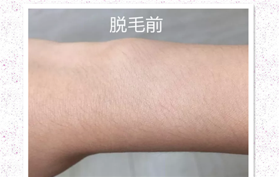 silkn脱毛仪使用频率 按这样的使用频率才更有效