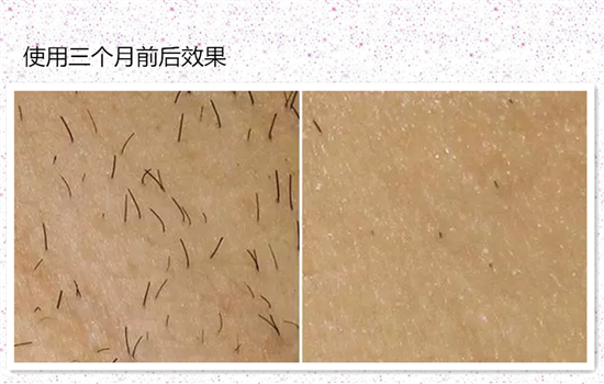 赛诺龙脱毛仪怎么样 常见家用脱毛仪里的全能选手