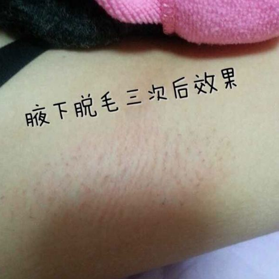 雅萌脱毛仪效果怎么样 勤快点用yaman变成萌萌的水煮蛋