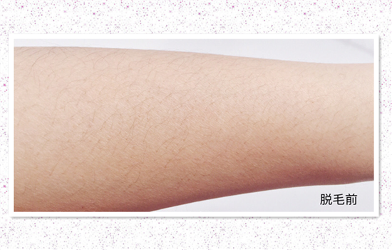 雅萌脱毛仪闪灯次数是多少 深扒yaman脱毛仪参数