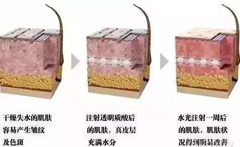 水光针怎样注射 你打的水光针为什么没有用