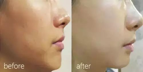 水光针怎样注射 你打的水光针为什么没有用