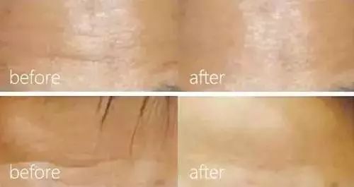 水光针怎样注射 你打的水光针为什么没有用