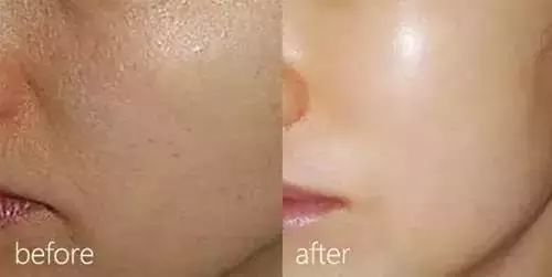 水光针怎样注射 你打的水光针为什么没有用