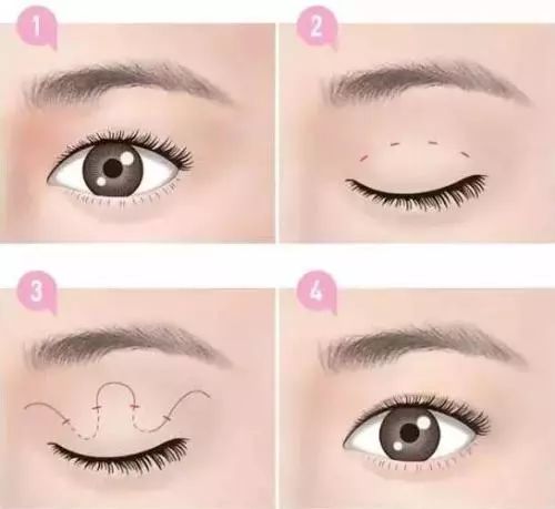 双眼皮是埋线好还是割的好 你知道做个双眼皮有多美吗?