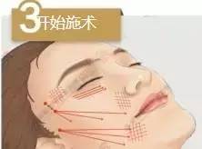 线雕是什么 线雕不是整容，是微调！！！