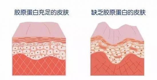 线雕提升能维持多久 线雕+玻尿酸，效果杠杠的！