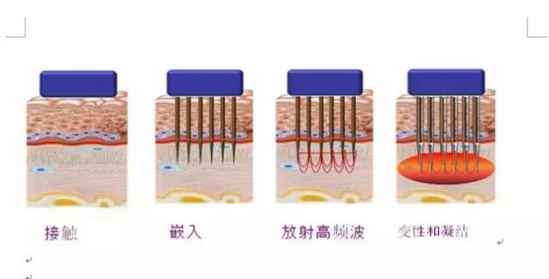 疤怎么去除