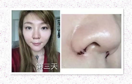 鼻翼缩小手术恢复过程图 鼻翼外切恢复过程图