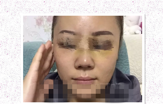 鼻修复失败案例