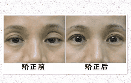 上睑下垂是什么 上睑下垂名词解释