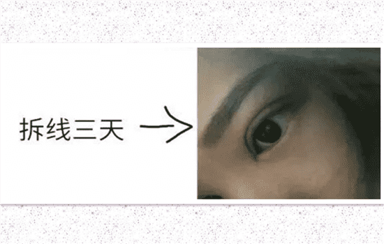 开内眼角一个月恢复图