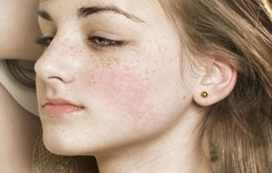 怎么治疗色斑万余挑选美姿尔 怎么治疗色斑